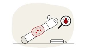 Illustration of a forearm with a swollen red area around bed bug bites and a damp cloth, with a bed bug under a magnifying glass