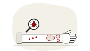 Illustration of a forearm with a line of bed bug bites next to raised hives, with a bed bug under a magnifying glass